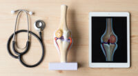 For Chronic Knee Pain, Genicular Artery Embolization Provides a New Alternative
